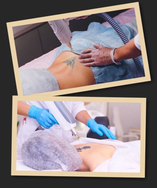 Лазерне видалення татуювання