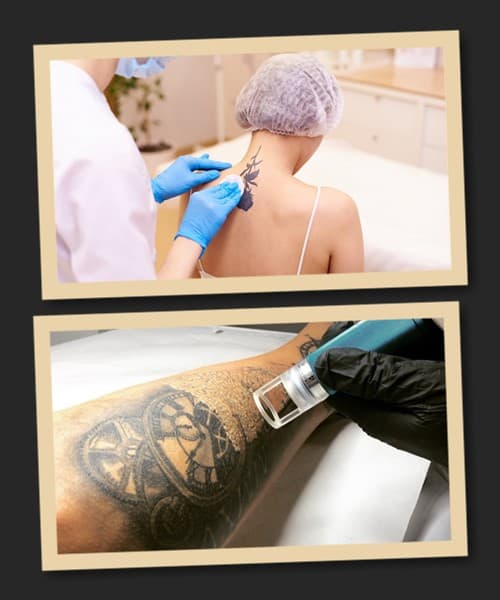 Лазерне видалення татуювань