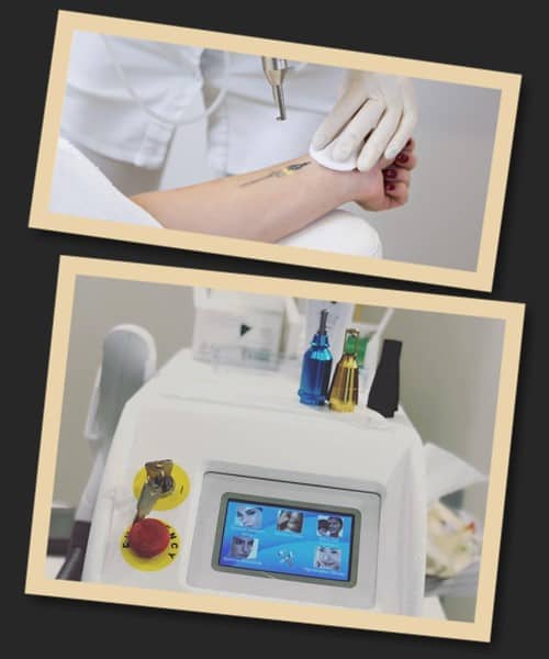 Види лазерних апаратів для видалення тату