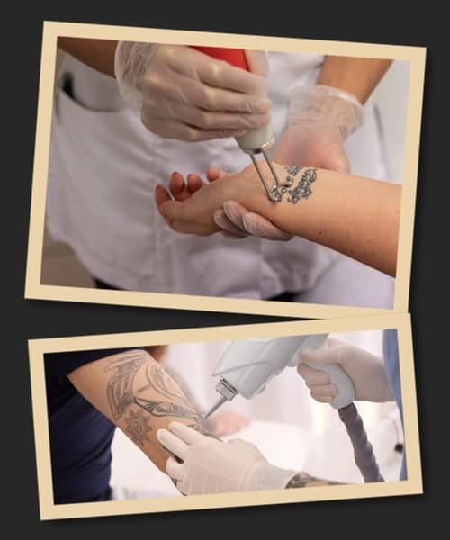 Переваги зведення тату лазером