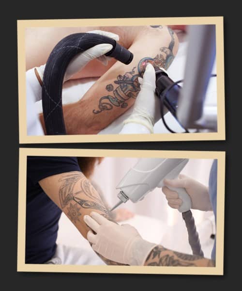 Особливості лазерів для зведення татуювань