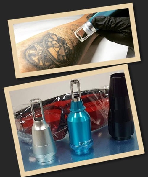 неодимовий лазер тату