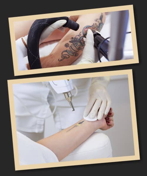 Лазери для видалення татуювань