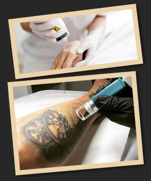 неодимовий лазер Q-Switched – найкращий