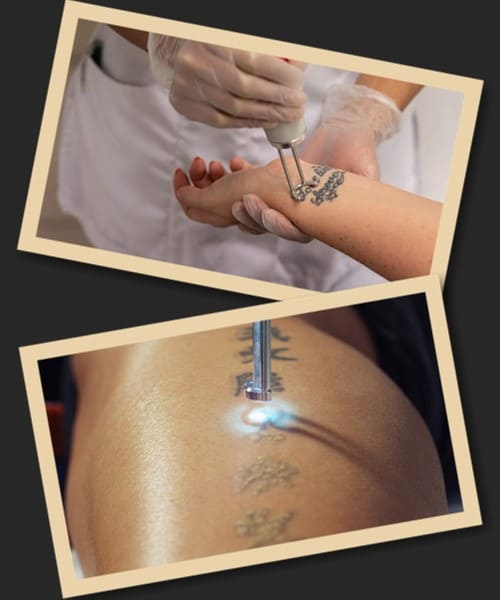 Як працює неодимовий лазер?