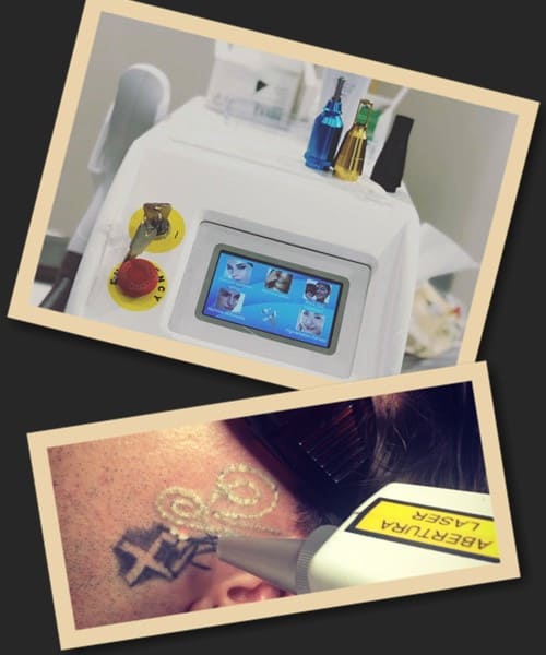 типи лазерів для видалення тату