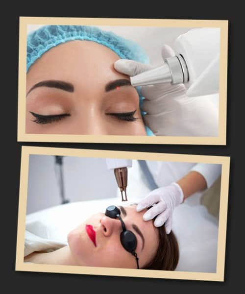 Видалення татуажу брів лазером: результат