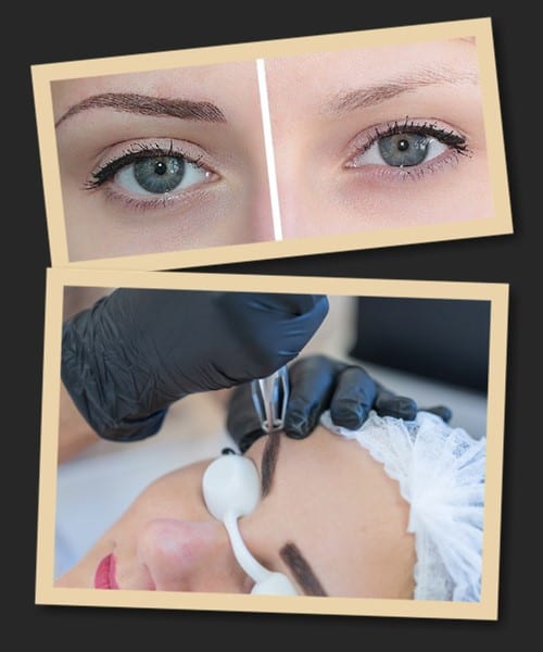 після видалення татуажу брови потемніли