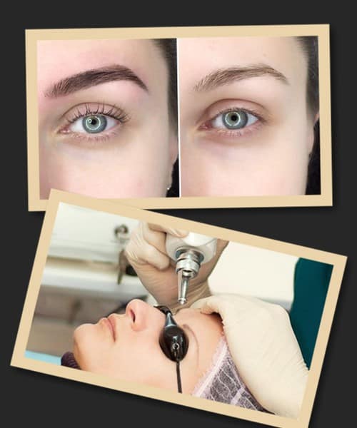 ефекти після видалення татуажу брів