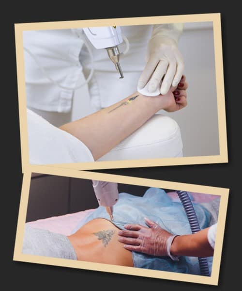 лазер для зведення татуювань