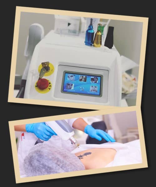 процесс удаления татуировки лазером