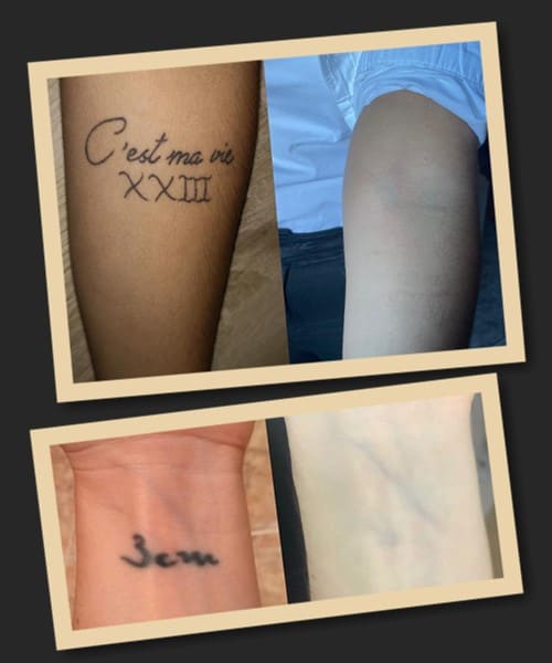 Видалити татуювання