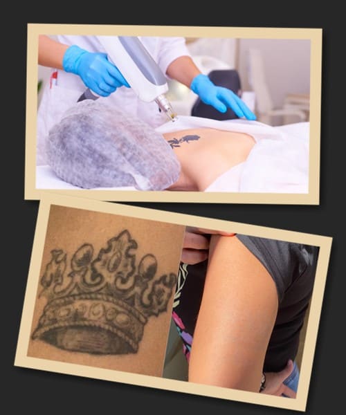 Способи видалення татуювань