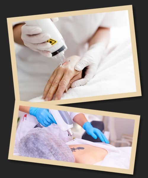 Які методи використовуються для зведення тату