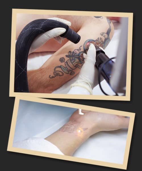 Скільки коштує видалити татуювання лазером