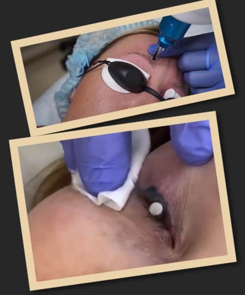 Причини видалення татуажу очей