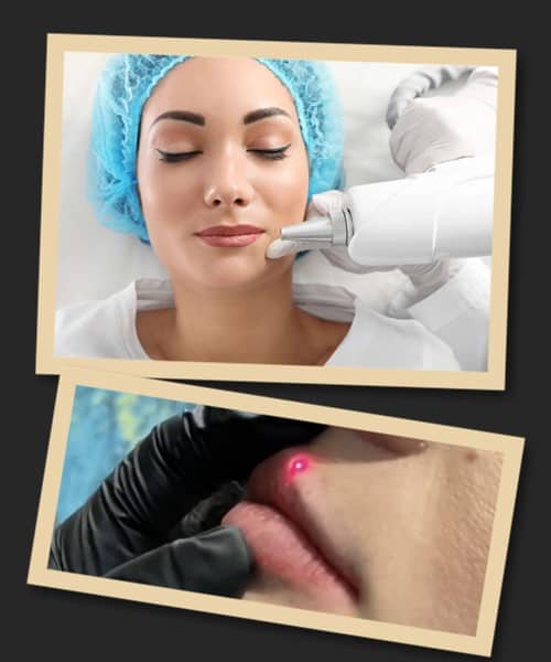 Прибрати татуаж губ лазером