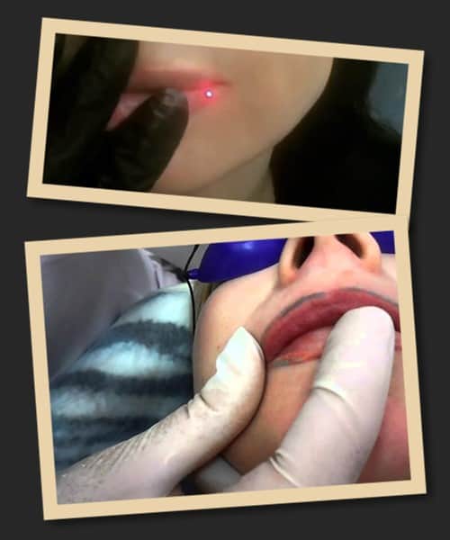 лазерний метод видалення татуажу