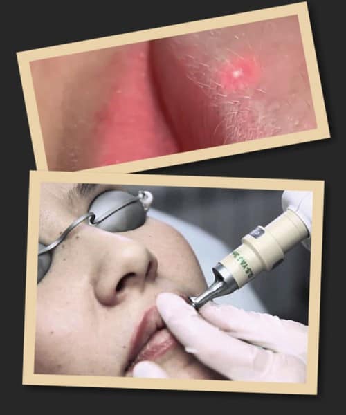 видалення татуажу губ лазеро