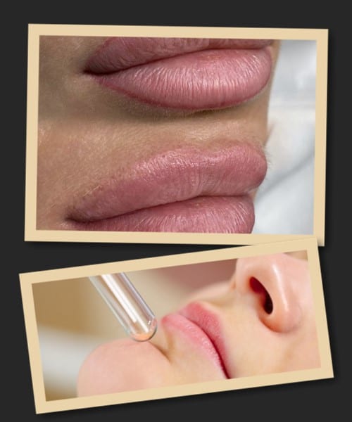 процедура лазерного виведення татуажу губ