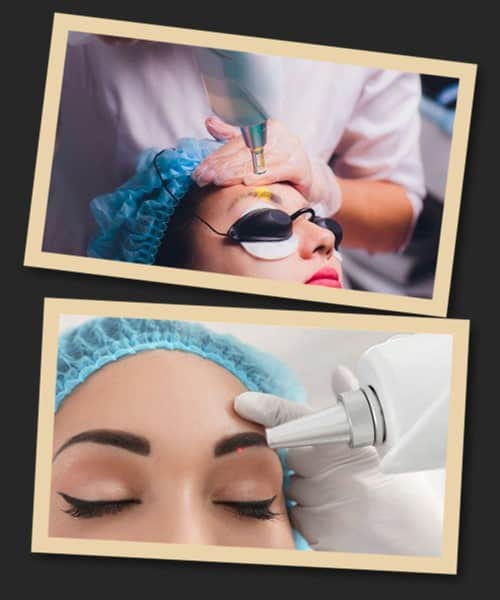 Татуаж брів: видалення лазером