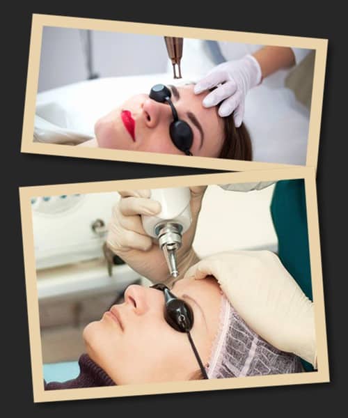 видалення лазером татуаж брів