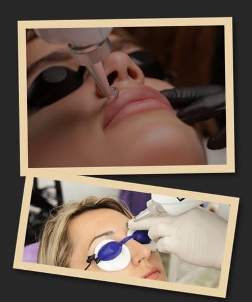 неодимовий лазер видалення татуажу