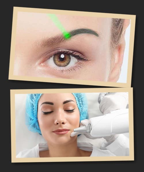 лазерний метод видалення татуажу