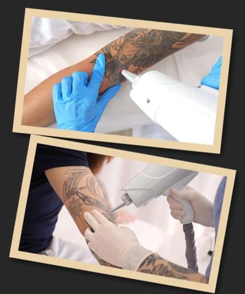 Видалення татуювання у Києві