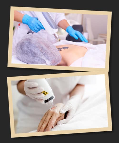 Якими методами видаляють татуювання