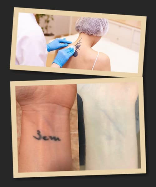 Видалення тату Печерський район