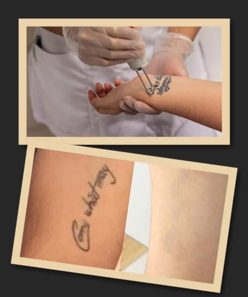 Скільки часу займе видалення тату