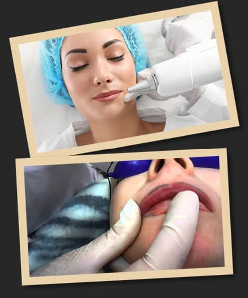 Видалення татуажу губ лазером