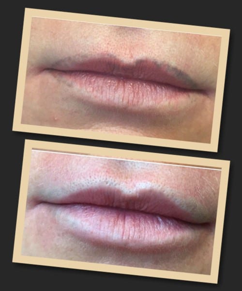 Що впливає на швидкість виведення татуажу губ