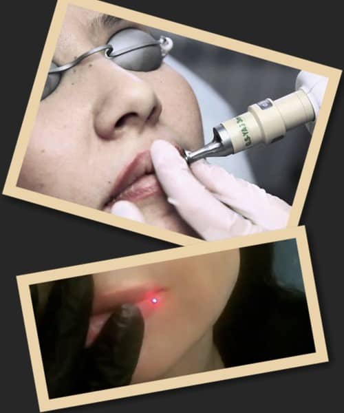 Переваги лазерного видалення татуажу губ