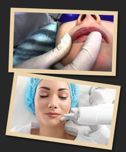 Видалення татуажу губ лазером