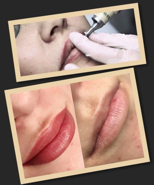 Видалення татуажу губ