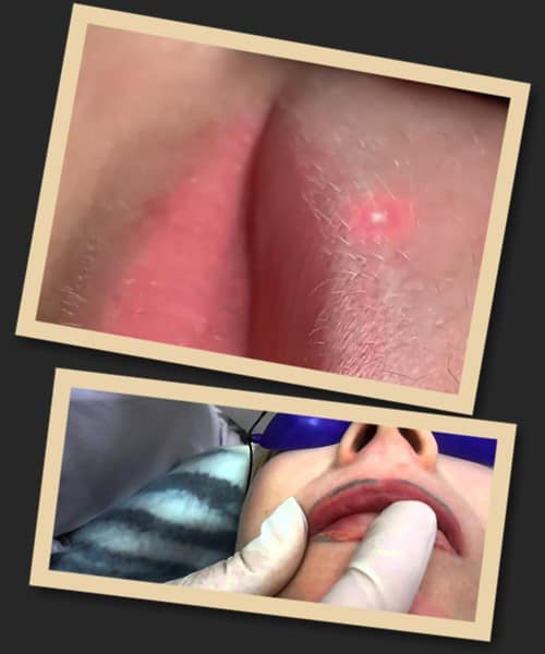 Видалення татуажу губ лазером