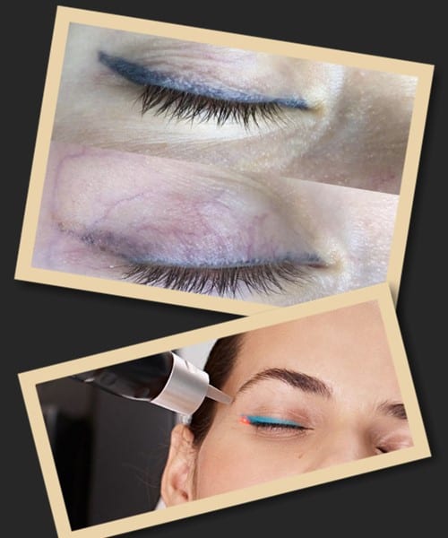 Методи виведення татуажу повік