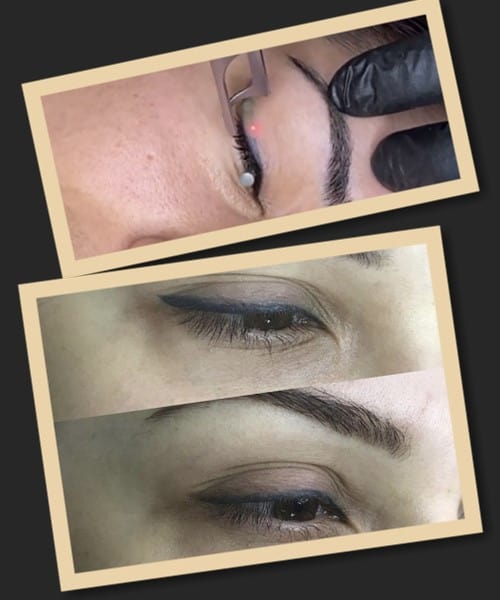 Видалення татуажу повік