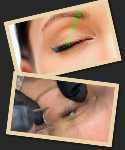 Особливості лазерного видалення татуажу повік