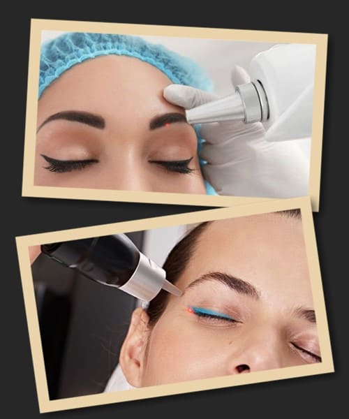 З яких причин видаляють татуаж?