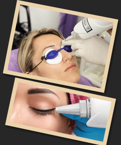 технології видалення перманентного макіяжу