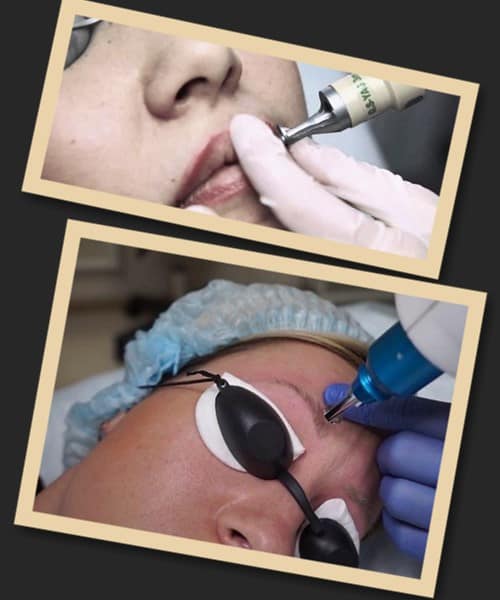 Лазерне видалення татуажу