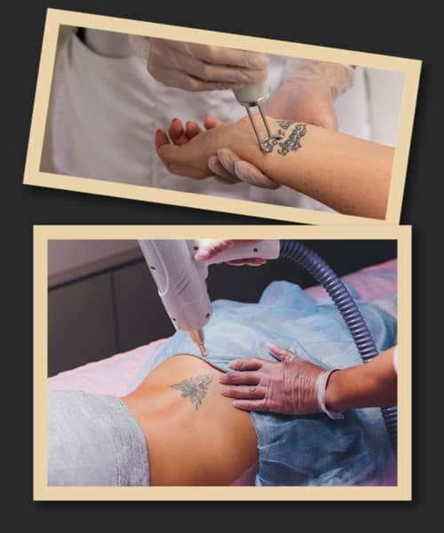 Що робити, щоб видалити татуювання