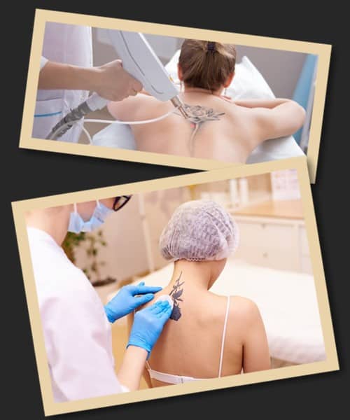 видаляю тату