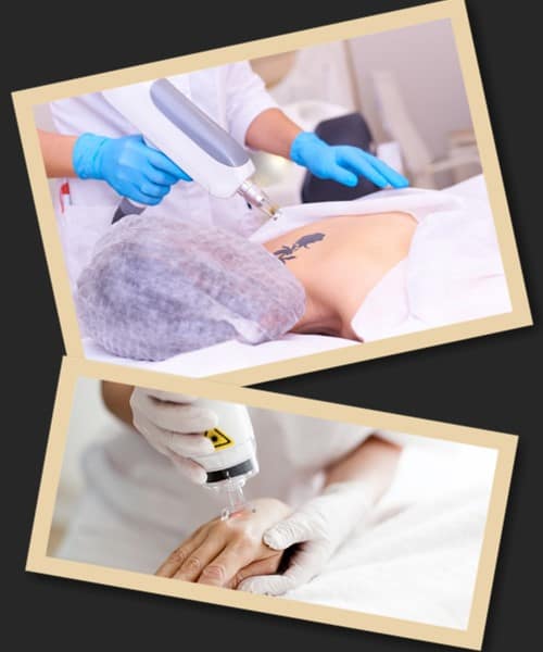 Які існують методи видалення тату