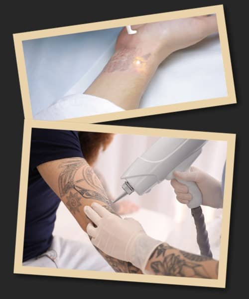 лазерне видалення тату