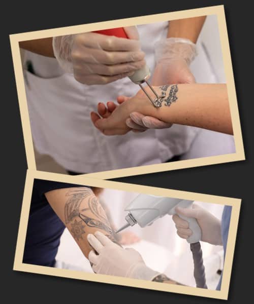 Все про видалення татуювання