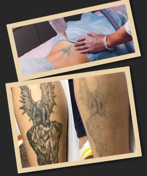 Основні методи видалення тату